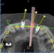 Cummings Blaise Axial View